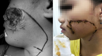 Nguy hiểm: Bé gái 8 tuổi bị chó nhà cắn lõm một bên má, 'vết thương nhầy nhụa dấu răng' trong lúc chơi đùa