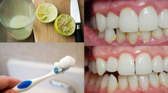 6 cách cạo sạch cao răng, giúp hàm răng trắng như sứ mà không cần đi nha sĩ
