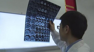 Bác sĩ gắp bỏ 30 con sán dây trong não người đàn ông có thói quen ăn thịt sống