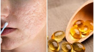 Mẹo trị sẹo lõm lâu năm bằng vitamin E - vị cứu tinh làn da cho cả hai phái