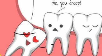 Răng khôn mọc dại: Những biến chứng nguy hiểm khó lường