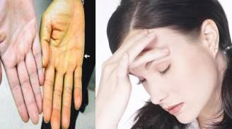 Dấu hiệu bệnh có thể được tiết lộ thông qua màu sắc lòng bàn tay
