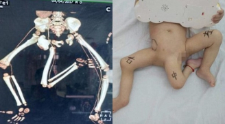 Kỳ lạ em bé có 3 chân tại Trung Quốc