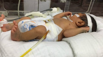 Bé sơ sinh 1,7kg bị vỡ dạ dày