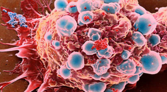 Trong cơ thể ai cũng có tế bào ung thư và đây là 3 nguyên tắc chặn đứng sự hình thành của khối u
