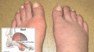 Dấu hiệu của bệnh gout