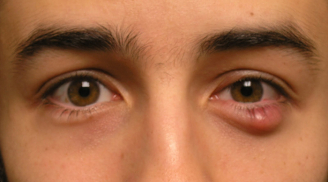 Cách chữa lẹo mắt thần tốc tại nhà không để lại sẹo