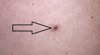 Cách kiểm tra nốt ruồi trên cơ thể có gây ung thư không