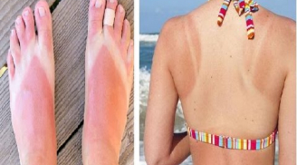 14 bí kíp làm giảm đau rát khi da bị cháy nắng