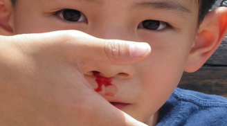 Cảnh báo nguy hiểm: Trẻ bị chảy máu cam có thể tử vong nếu ngửa đầu ra sau