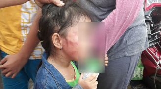 Bé gái 5 tuổi bị bảo mẫu tát đến nứt xương hàm, dọa cắt lưỡi vì nôn ói khi ăn