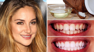 5 cách loại bỏ cao răng, giúp hàm răng trắng như sứ chỉ mất 5 phút tại nhà