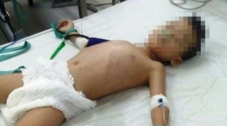 Bé trai 5 tuổi bị người tình của mẹ bạo hành đến hôn mê nguy kịch