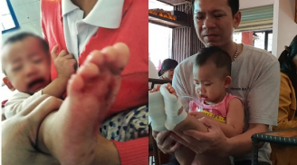 Bé gái 18 tháng tuổi bị phỏng bất thường ở chân khi đi học ở trường mầm non