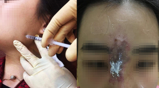 Nữ sinh 19 tuổi biến dạng mặt, suýt mù mắt vì tiêm filler nâng mũi