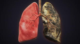 Người có thói quen này dễ mắc ung thư phổi gấp 30 lần, tránh ngay kẻo gặp 'tử thần' sớm