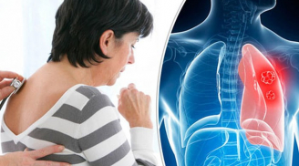 4 dấu hiệu ung thư phổi sớm nhất, đi khám ngay để tự cứu lấy mình