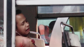 Nam thanh niên mất cánh tay sau một giấc ngủ trên xe buýt vì lý do rùng mình