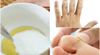 Lấy 1 quả chanh làm theo cách này mụn cóc xấu xí lặn mất tăm chỉ trong 1 tuần, da dẻ lại mịn màng