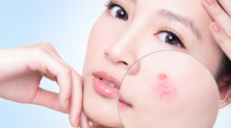 Dùng dầu dừa chính là cách trị mụn tại nhà hiệu quả và nhanh nhất giúp làn da sáng hồng căng mọng