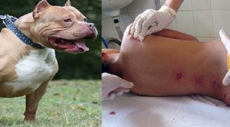 Người đàn ông bị chó Pitbull 30 kg cắn rồi lôi xuống hồ phải nhập viện
