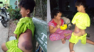 Bé trai 7 tuổi khuyết tật bị cô giáo đánh bầm tím khắp người gây phẫn nộ