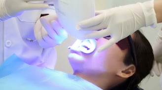 Tẩy trắng răng bằng laser có đem lại hiệu quả như ý?