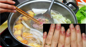 Lời cảnh báo từ vụ: Người phụ nữ ngứa đến chảy máu da vì thường ăn thứ mà nhiều người thích khi trời lạnh