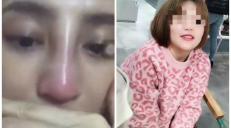 Lời cảnh tỉnh sau vụ: Cô gái 19 tuổi tử vong do biến chứng gây mê khi nâng mũi bằng sụn tai