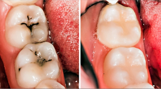 Nha sĩ tiết lộ 10 cách đơn giản để ngăn ngừa sâu răng không cần dùng thuốc