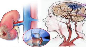 Chỉ vì uống nước kiểu này nên đã mắc sỏi thận, phù thũng, tai biến mạch máu não