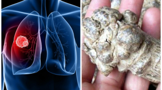 Bác sĩ tiết lộ vị thuốc quý dễ tìm giúp bệnh nhân ung thư phổi kéo dài sự sống thêm 20 năm