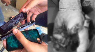 Hãi hùng bé trai 13 tuổi bị cắt cụt bàn tay do vừa sạc pin vừa dùng điện thoại
