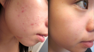 Thấy mụn cứ lên chi chít như rừng amazon chắc chắn bạn sẽ day dứt cả đời nếu không biết thứ này sớm hơn!
