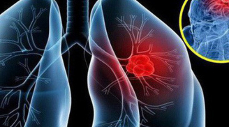 Người phụ nữ 58 tuổi bị ung thư phổi vẫn sống khỏe gần chục năm nhờ phương pháp vô cùng đặc biệt