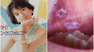 Nữ diễn viên 'Chiaki, cố lên!' cắt hơn 1/2 lưỡi vì ung thư: Cảnh báo thấy dấu hiệu này cần đi khám gấp