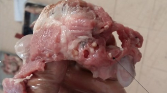 Nghi nhiễm sán lợn, 400 trẻ mầm non ở Bắc Ninh được đi xét nghiệm: Ăn thịt nhiễm sán nguy hiểm thế nào?