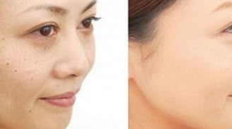 TOP 4 cách trị tàn nhang cực đơn giản, các nàng mê ngay trong lần đầu thực hiện