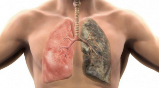 Trả lời CÓ với 6 câu hỏi này: Hãy đến gặp bác sĩ gấp vì tế bào ung thư đang lớn dần trong phổi