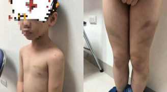 Bé trai 7 tuổi bị bố bạo hành dã man, bầm tím khắp cơ thể khiến dư luận phẫn nộ