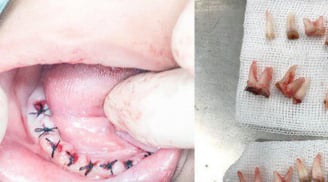 Cảnh báo sau vụ: Cậu bé 4t mất đi toàn bộ 18 chiếc răng vì thói quen lặp đi lặp lại của bố mẹ