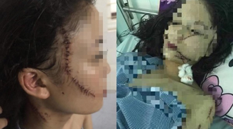 Hãi hùng cô gái 18 tuổi bị nhóm người dùng dao lam rạch mặt, cứa cổ dã man trong đêm