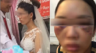 Sự thật 'ngã ngửa' bức ảnh cô dâu bị đánh thâm tím mặt mày vì từ chối hôn chú rể trong đám cưới