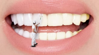 Răng trắng bóc sau khi tẩy bằng baking soda nhưng lợi bất cập hại