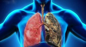 6 việc giúp 'giải phóng' phổi khỏi bệnh tật, ung thư, người còn khoẻ phải làm ngay kẻo mang hoạ