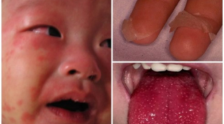 Trẻ em sốt nhiều ngày liên tục kèm mắt đỏ bố mẹ chớ chủ quan kẻo hối hận không kịp