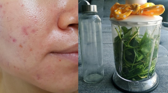 Mẹ 2 con mặt nổi đầy mụn nội tiết bỗng sáng mịn không tỳ vết chỉ sau 3 tháng uống nước rau má