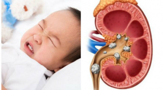 Bé 20 tháng tuổi tìm thấy sỏi thận: Bác sĩ nói nguyên nhân chỉ vì mẹ quá thương con gây hậu quả khôn lường