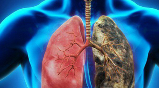 7 dấu hiệu sớm của ung thư phổi rất nhiều người bỏ qua, nguy hiểm nhất là số 5