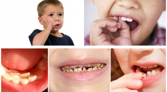 Bé 3 tuổi nghiện kẹo nhưng lười đánh răng, bố mẹ sốc khi con bị vi khuẩn ăn lên mắt
